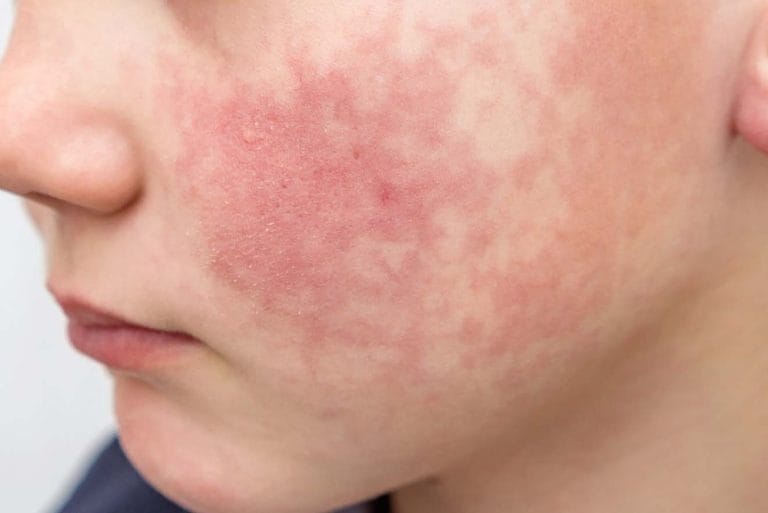 Exantemul subit la copii: simptome, cauze și tratament complet Exantemul subit