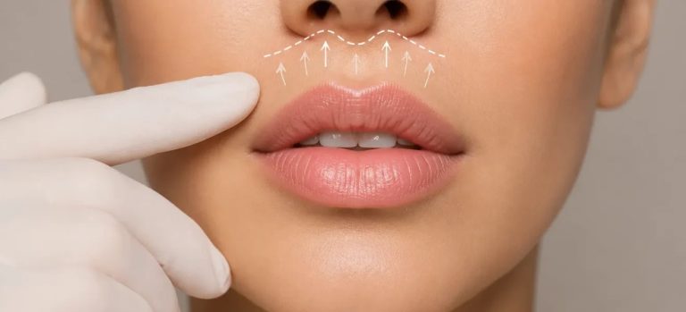 Lip Lift: ce este intervenția care poate modifica proporțiile buzei superioare 2